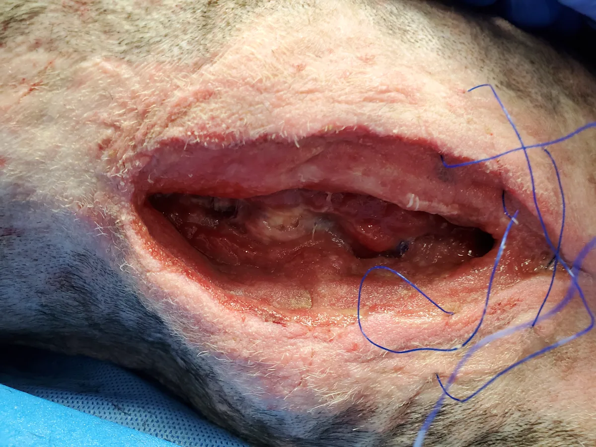 A close-up of the healing open incision with a small amount of granulation tissue present. 