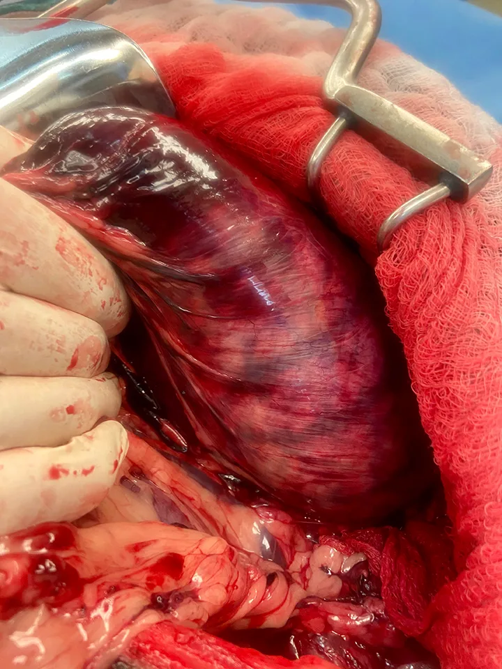 Intraoperative image of stomach discolored in a dark purple and white-to-pink striped pattern.