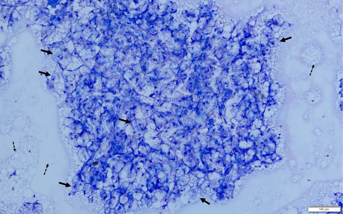 Microscopic image showing cells from a liver aspirate.
