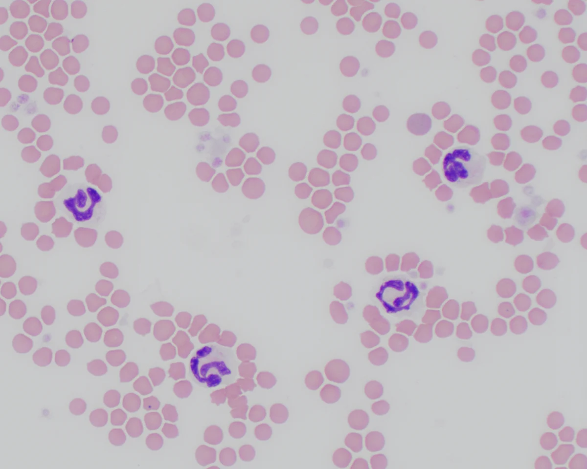 Side-by-side blood smears showing numerous red blood cells and several white blood cells.