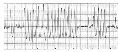 ECG tracing with two different QRS morphologies and a severely elevated heart rate. Most are the wide and bizarre complexes typical of ventricular beats and there is also a normal sinus beat. 