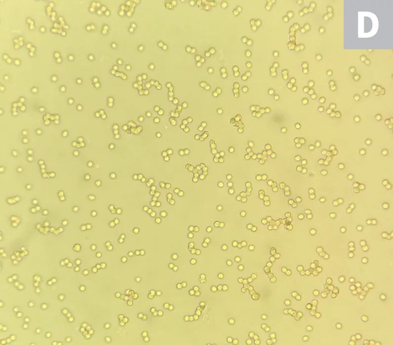 Microscope images of RBCs showing agglutination (A) and rouleaux (B).