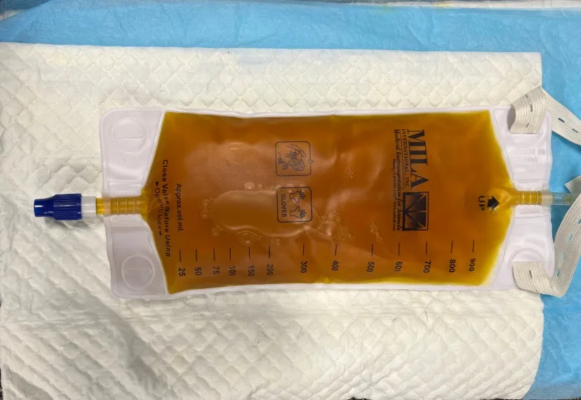 IV bag filled with brownish-yellow urine.