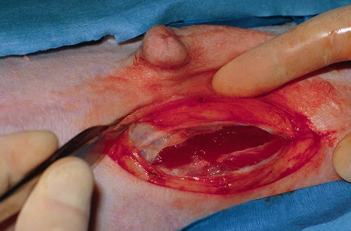 A paramedian incision is held open by the surgeon’s hands to show the rectus abdominus muscle layer.
