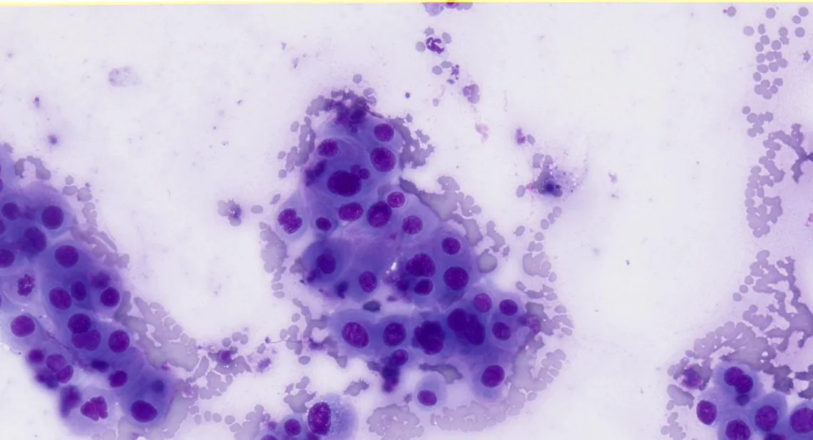 Cytology of pleural fluid showing sheets of irregular round nucleated cells.