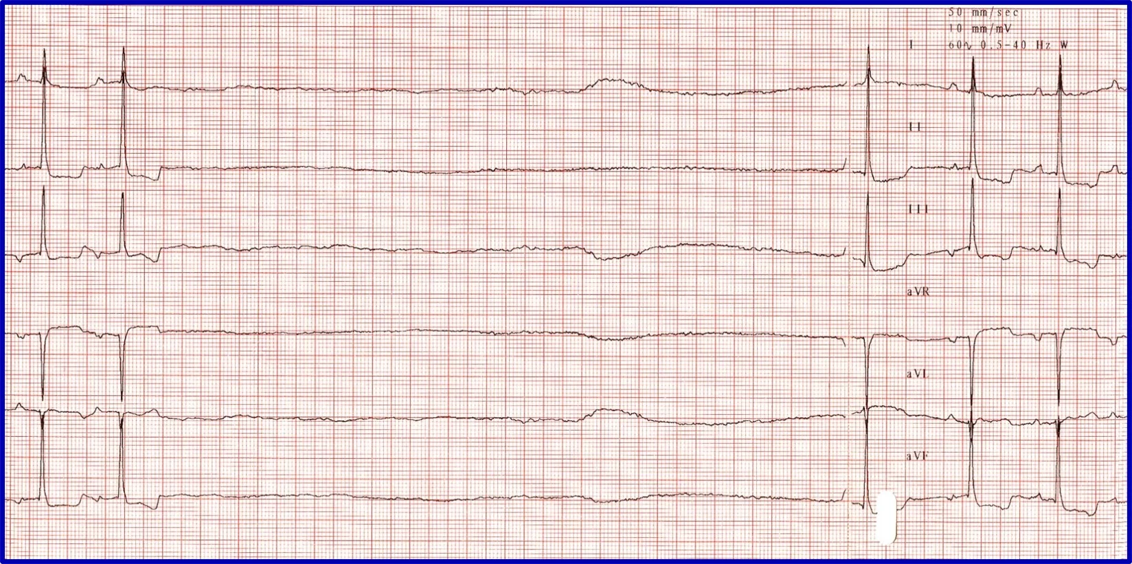 Figure 8A: A 6-lead ECG showing a long pause and delayed rescue beat. Figure 8B: A post-atropine ECG normal beats but bradycardia.