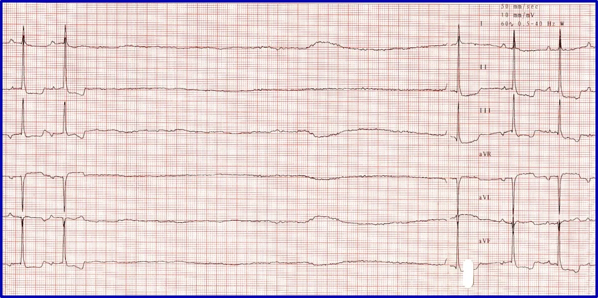 Figure 8A: A 6-lead ECG showing a long pause and delayed rescue beat. Figure 8B: A post-atropine ECG normal beats but bradycardia.