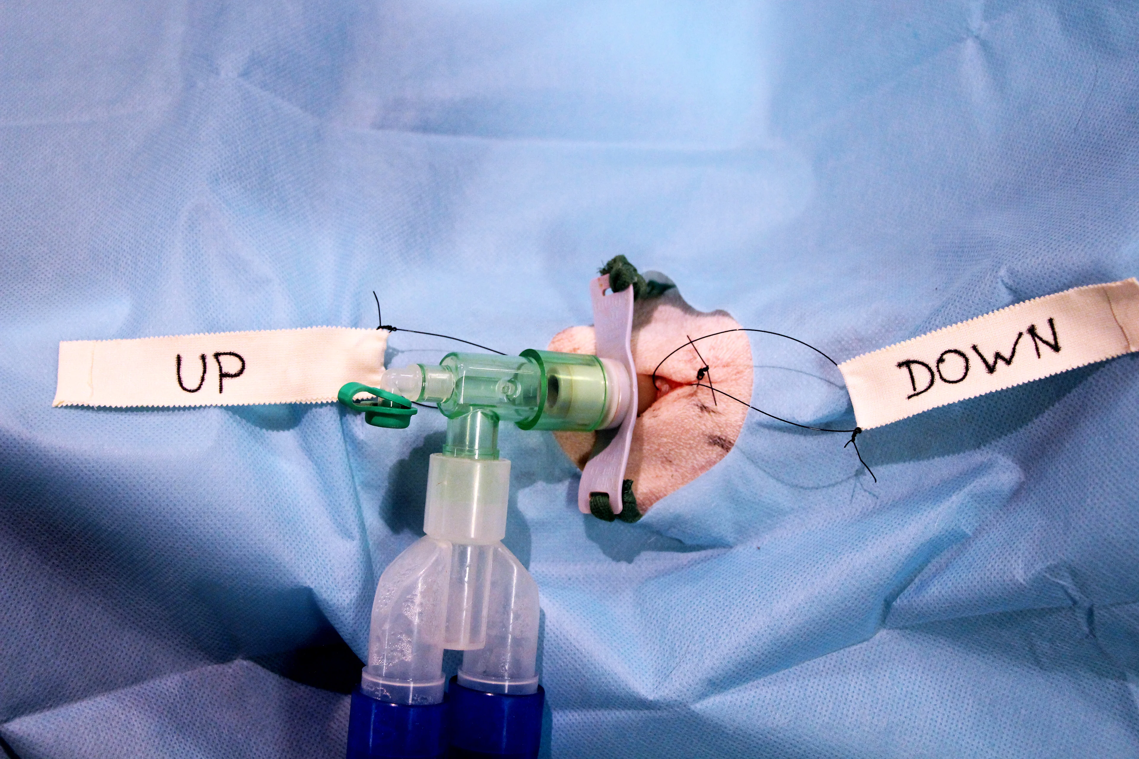 Tracheostomy tube in place with sutures labeled with surgical tape to indicate what direction to pull sutures to open site.