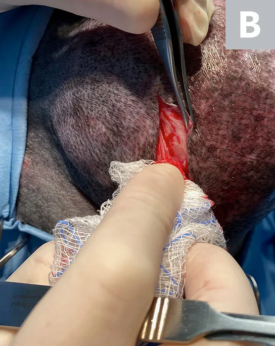 Gloved hands holding gauze over skin incision before and after incising through SC tissue.