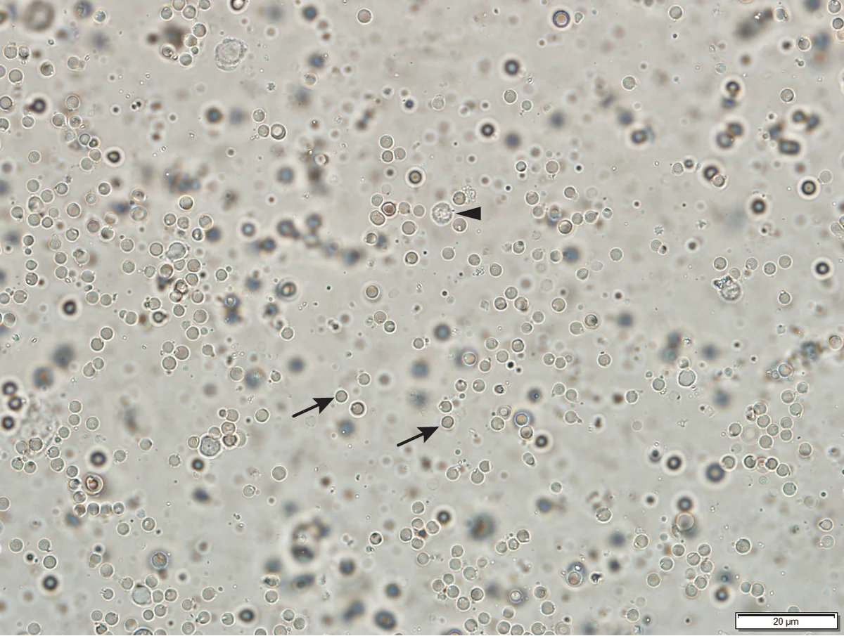 Cytology slide showing numerous small and few slightly larger round cells against a clear background.
