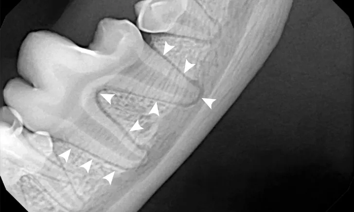 Dental x-ray of mandibular first molar with arrowheads pointing to normal periodontal ligament.