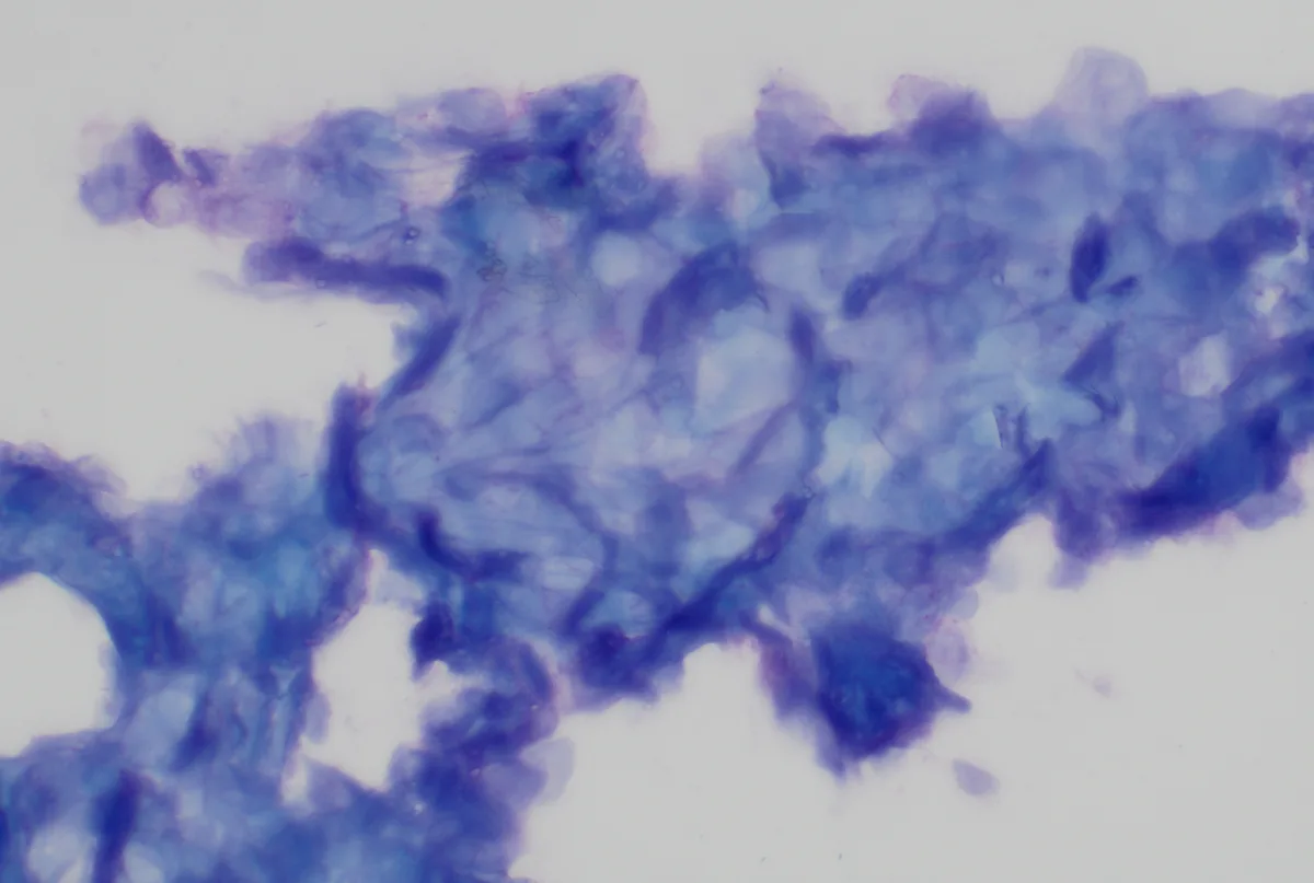 Sheets of irregular, variably shaped, angular, light-blue staining anuclear cells.
