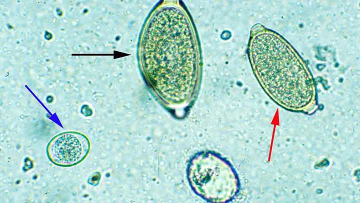A microscopic image showing three different types of parasite eggs indicated by colored arrows. 