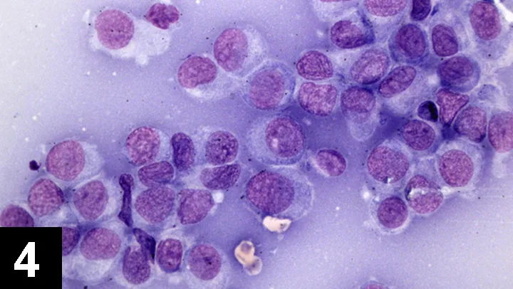 Stained cytology slide showing clusters of round cells with large purple-stained nuclei.