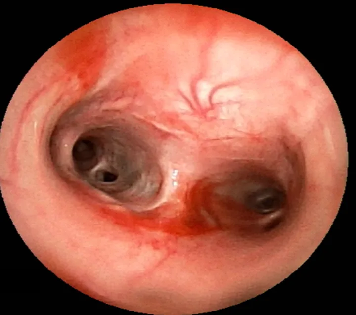 Tracheobronchoscopy image of carina in a dog.
