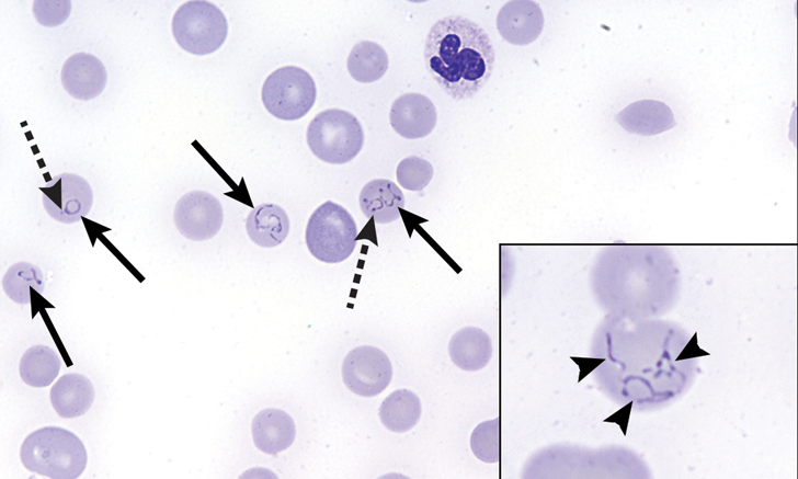 Babesiosis: Image Gallery | Clinician's Brief