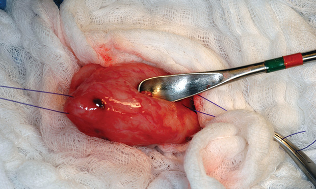 Emergency Urinary Bladder Surgery