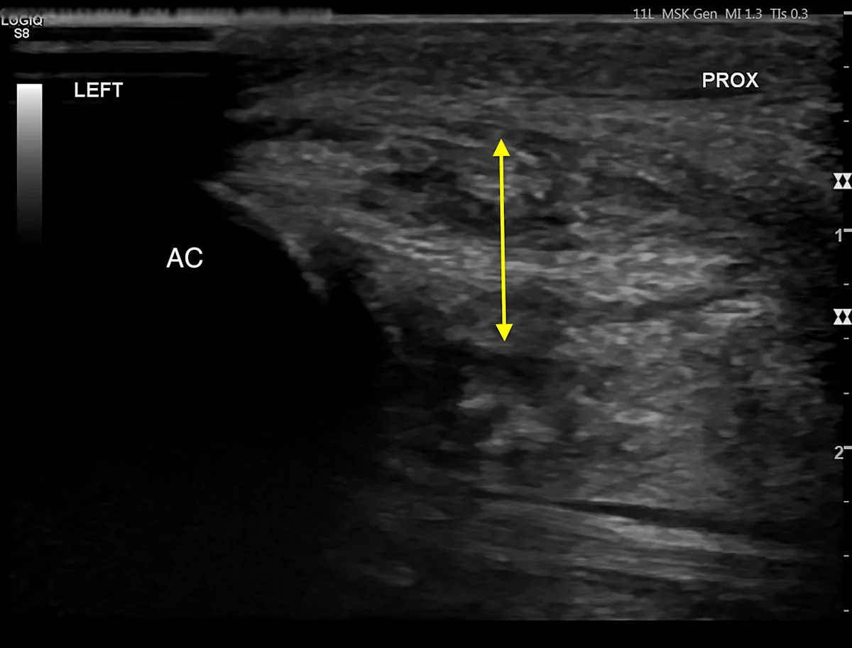Ultrasound images comparing normal and abnormal flexor tendons in a dog.