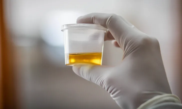Gloved hand holding up a urine sample.