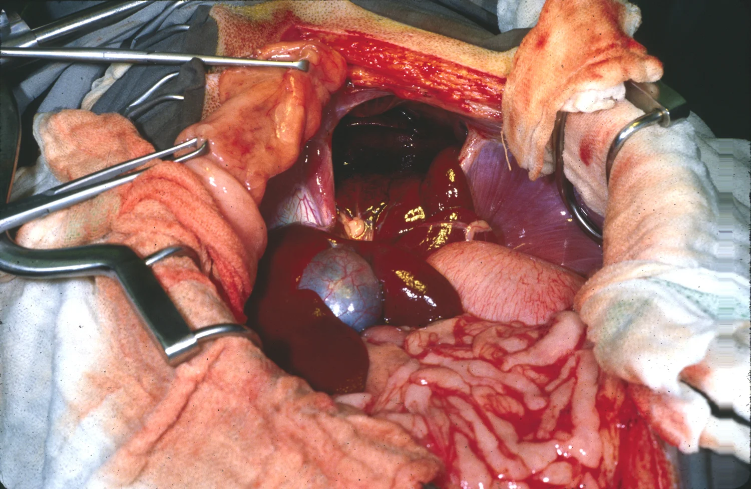 How to Close a Diaphragmatic Hernia: Step-by-Step Guide, image size:1500x976