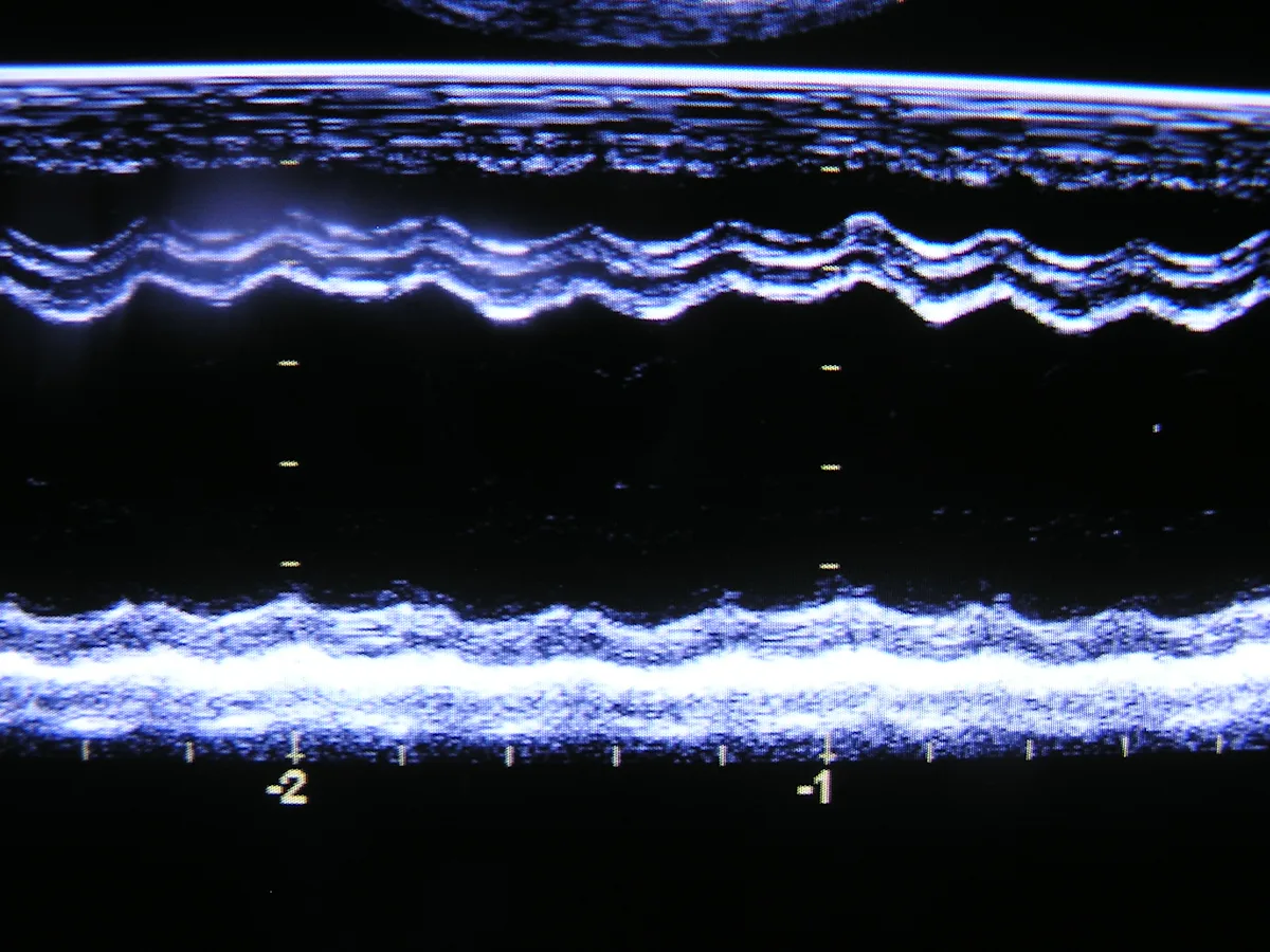 M-mode echocardiogram revealing both decreased fractional shortening and changes in ventricular diameter.