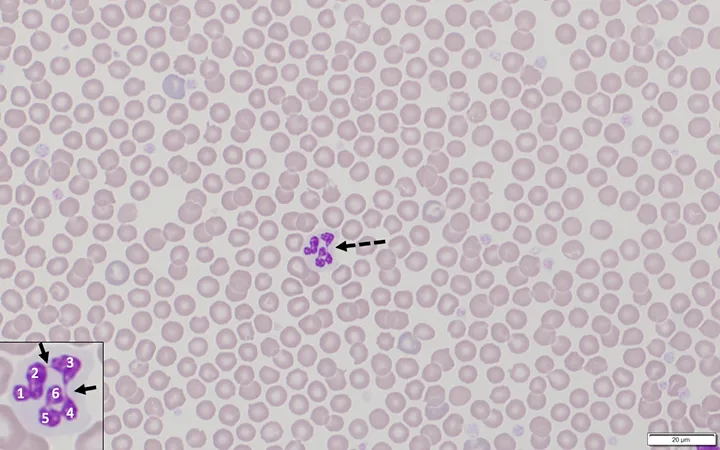 Blood smear showing numerous RBCs and a single hypersegmented neutrophil with inset showing details of the neutrophil.