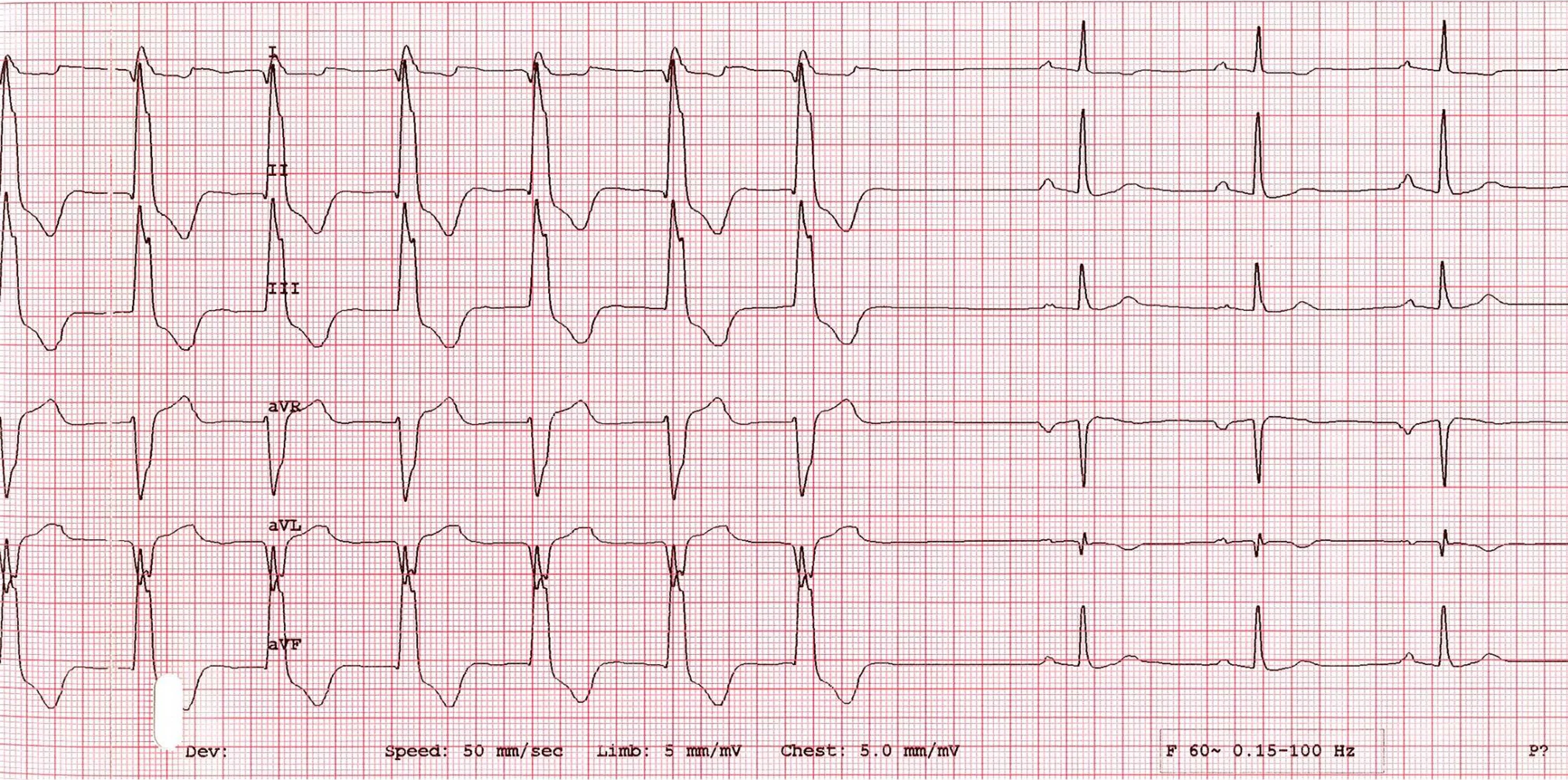 A 6-lead ECG with runs of ventricular ectopy. 