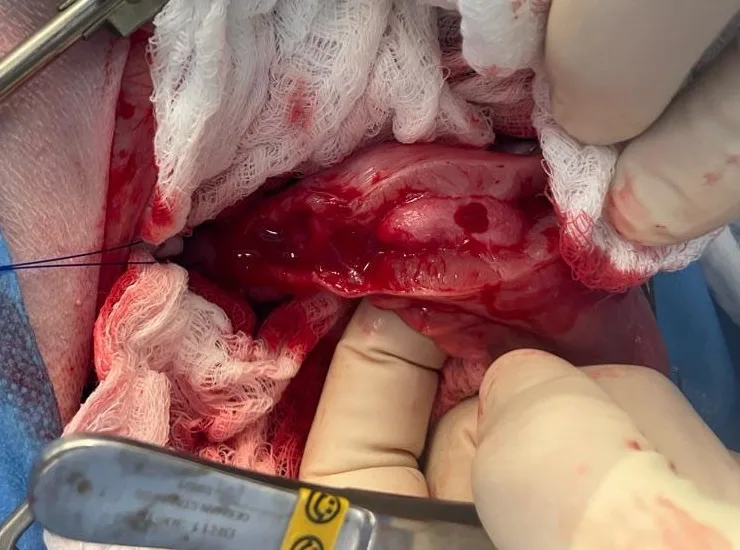 Gloved hands swabbing blood from a partial-thickness pyloric incision.