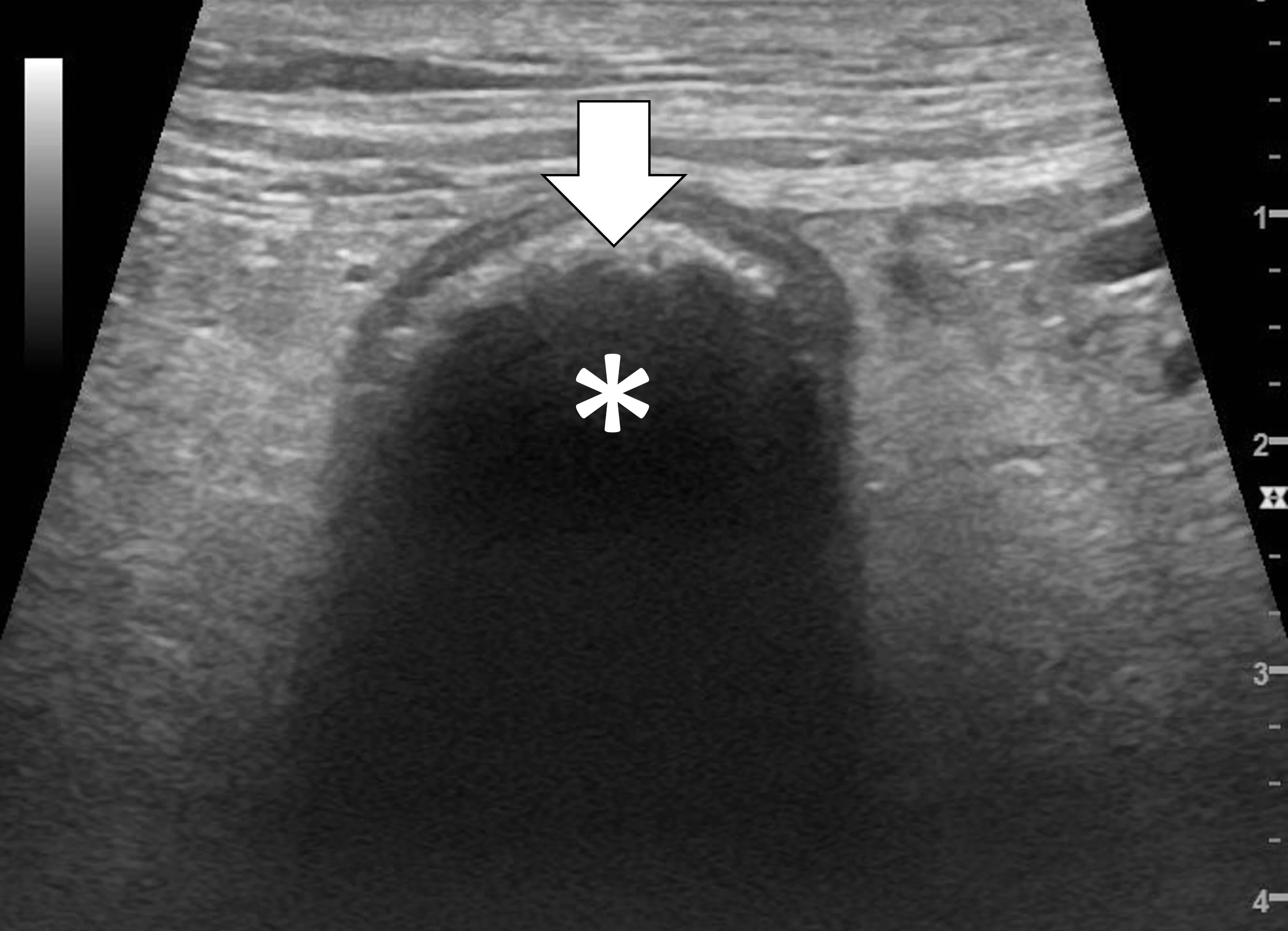 Abdominal ultrasound image demonstrating changes associated with a cloth foreign body.