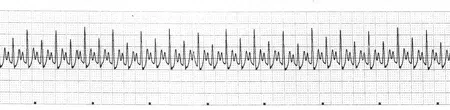 ECG tracing showing heart rate of ~240 bpm with a P-QRS-T complex present for every beat, but with QRS amplitude alternating between tall and short on successive beats.