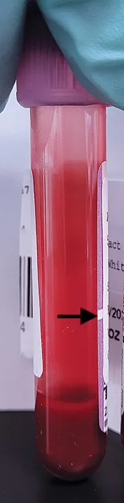Purple-top test tube containing small amount of blood and arrow pointing to line on tube located well above the blood.