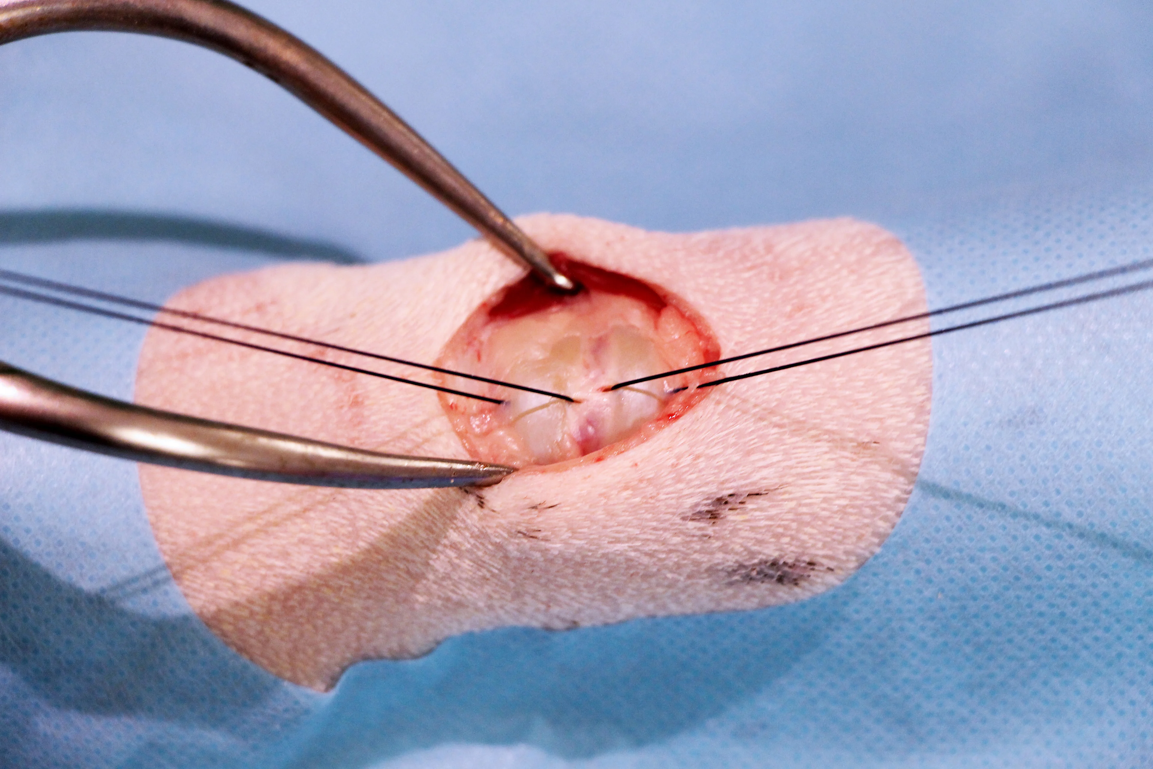 Traction being applied to sutures around tracheal rings and appearance of trachea after incising between sutures.