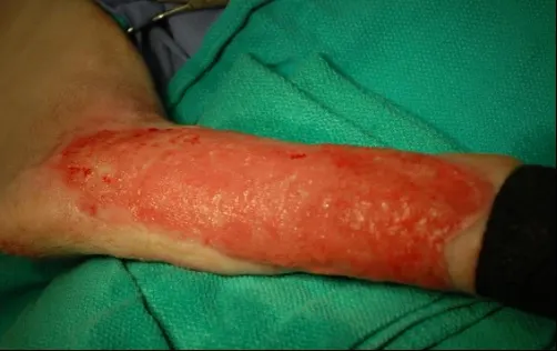 Healthy granulation tissue bed ready for free skin grafting.