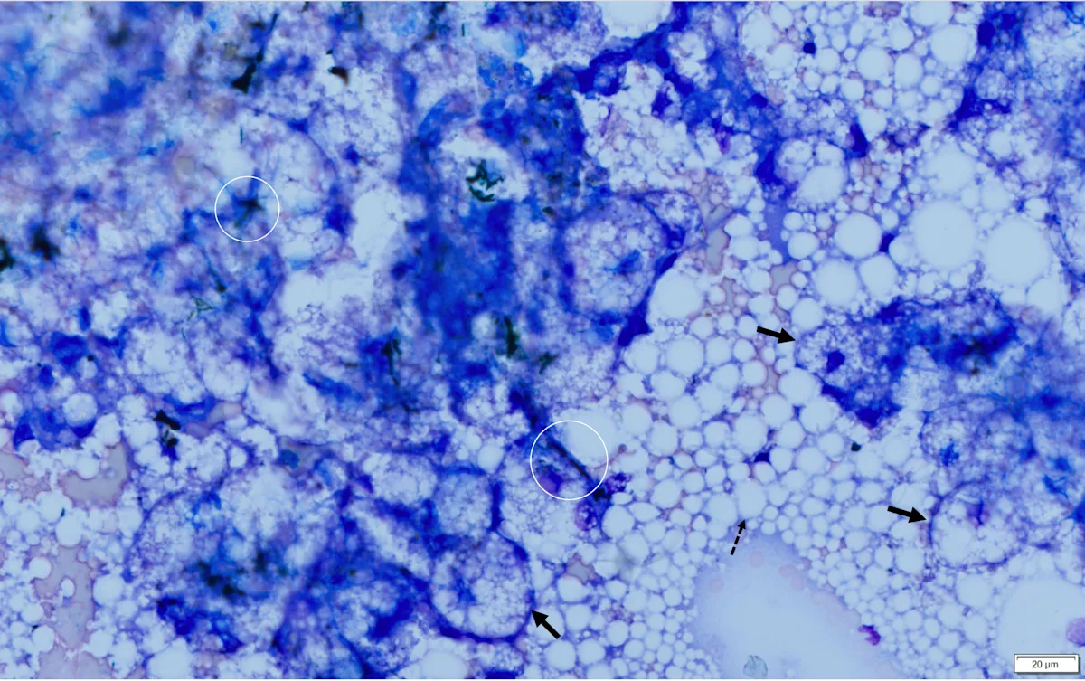 Additional magnification of microscopic image of cells from a liver aspirate.