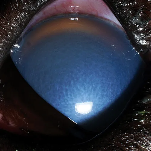 Severely dilated pupil with mostly opaque cornea and pink conjunctiva.