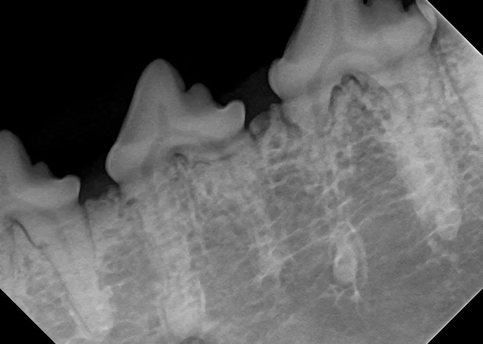 Four dental radiographs showing different root anomalies that can contribute to root fracture during extraction. 
