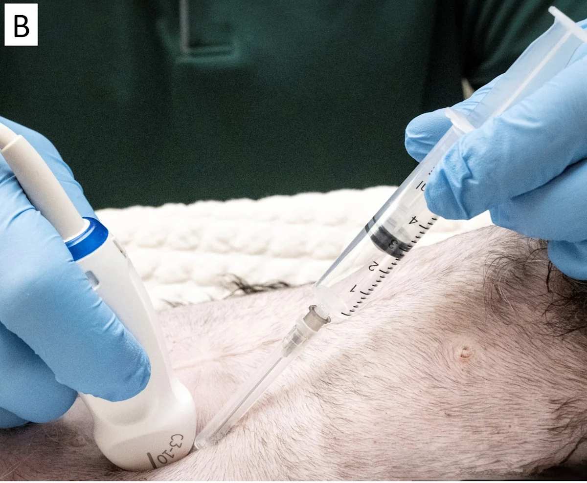 Gloved hands holding ultrasound transducer and syringe showing various angles of the syringe relative to abdomen.
