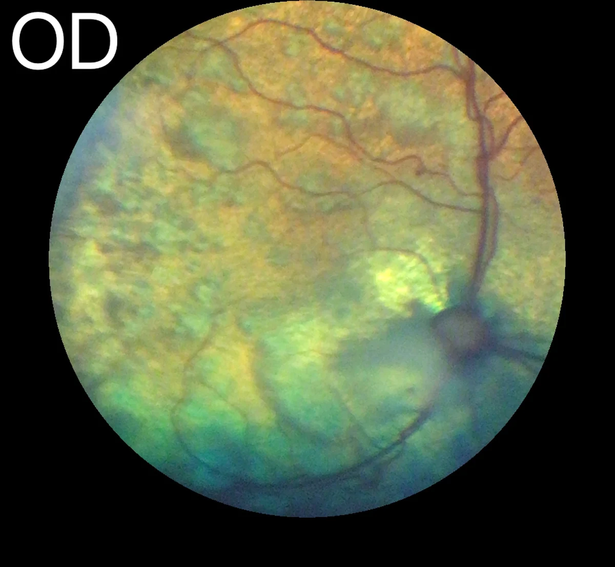 Retinal detachments in a cat’s eye.