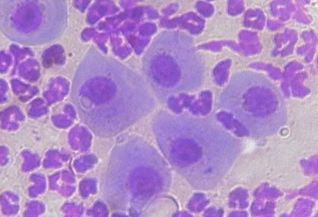 Cytology of irregularly shaped pale-staining nucleated cells surrounded by numerous smaller neutrophils.