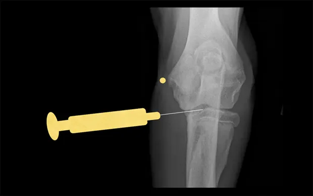Craniocaudal radiograph of a canine elbow joint showing a needle inserted into the joint space.