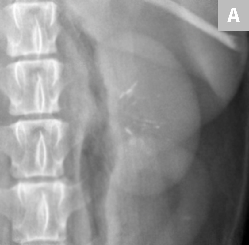 Diagnostic Imaging of Urinary Tract Calculi Clinician's Brief