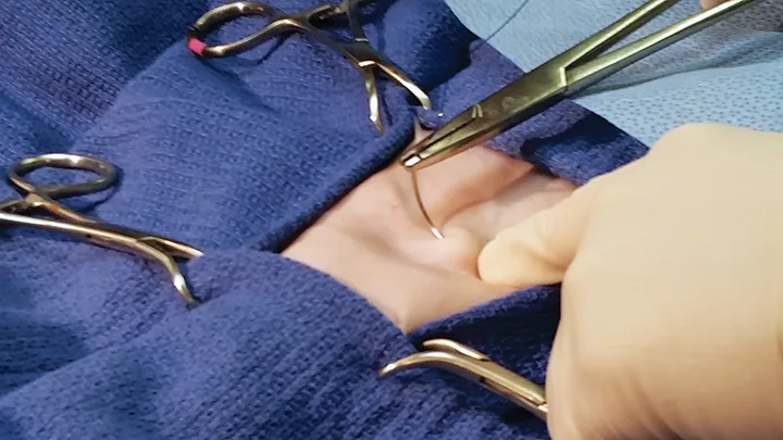 Surgically draped, shaved skin with a surgeon placing the initial suture.