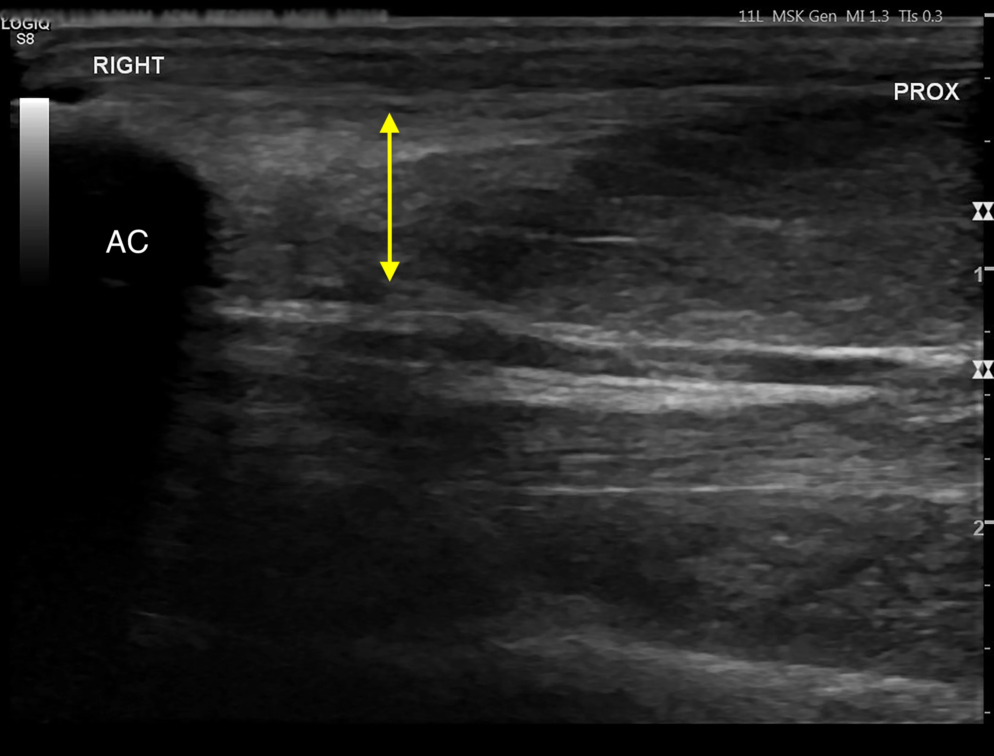Ultrasound images comparing normal and abnormal flexor tendons in a dog.