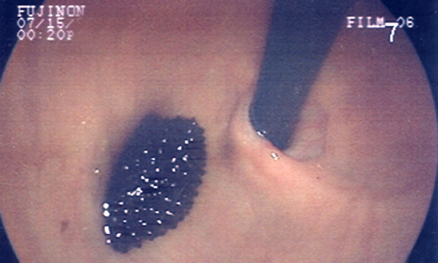 online-gallery-normal-and-abnormal-findings-for-upper-endoscopy