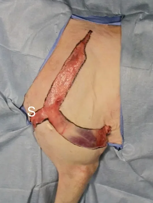 Front Leg Amputation in a Dog Clinician's Brief