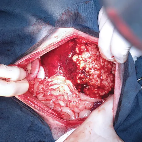 Intraoperative image of dog liver multiple white nodules of varying sizes located throughout majority of organ.