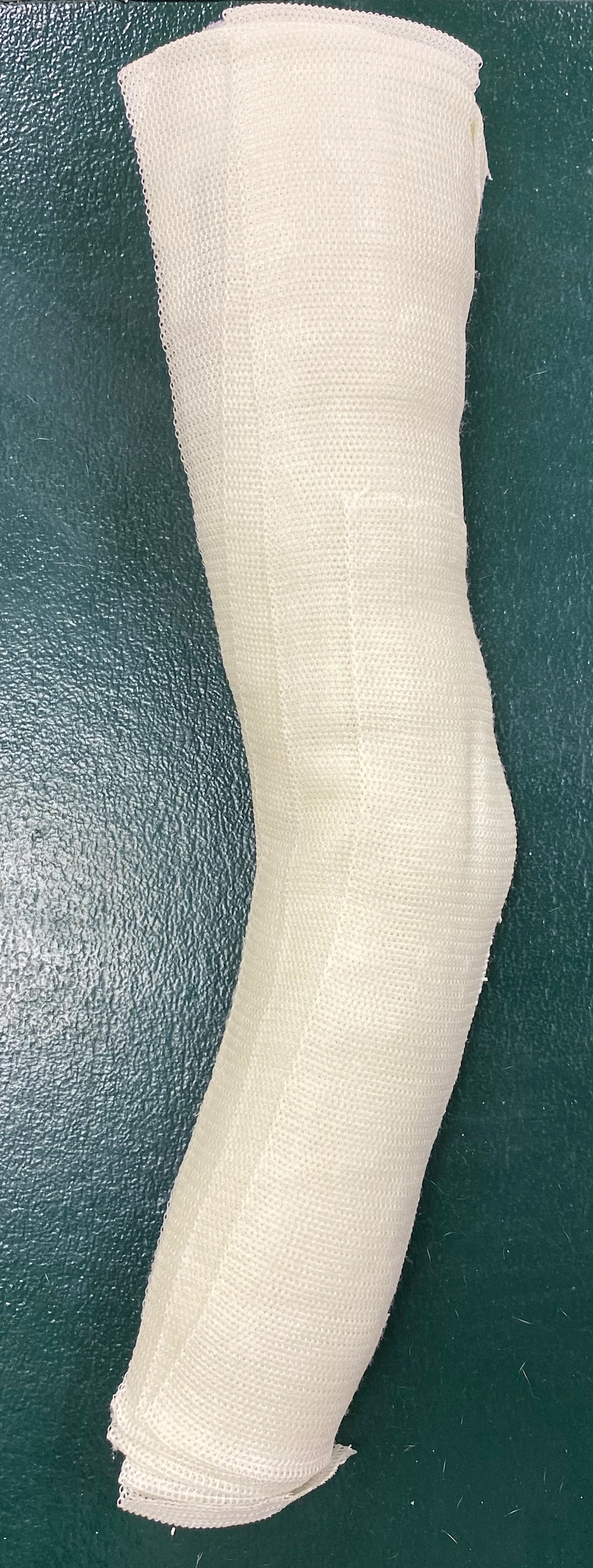 Example of molded fiberglass splint.