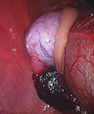 A laparoscopic image shows an undescended testicle and a normal urinary bladder. 