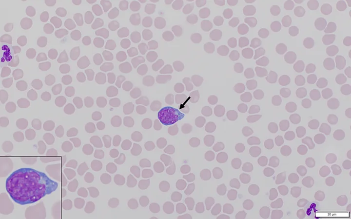 Blood smear showing numerous RBCs and arrow pointing to a large lymphocyte with inset showing details of the lymphocyte.