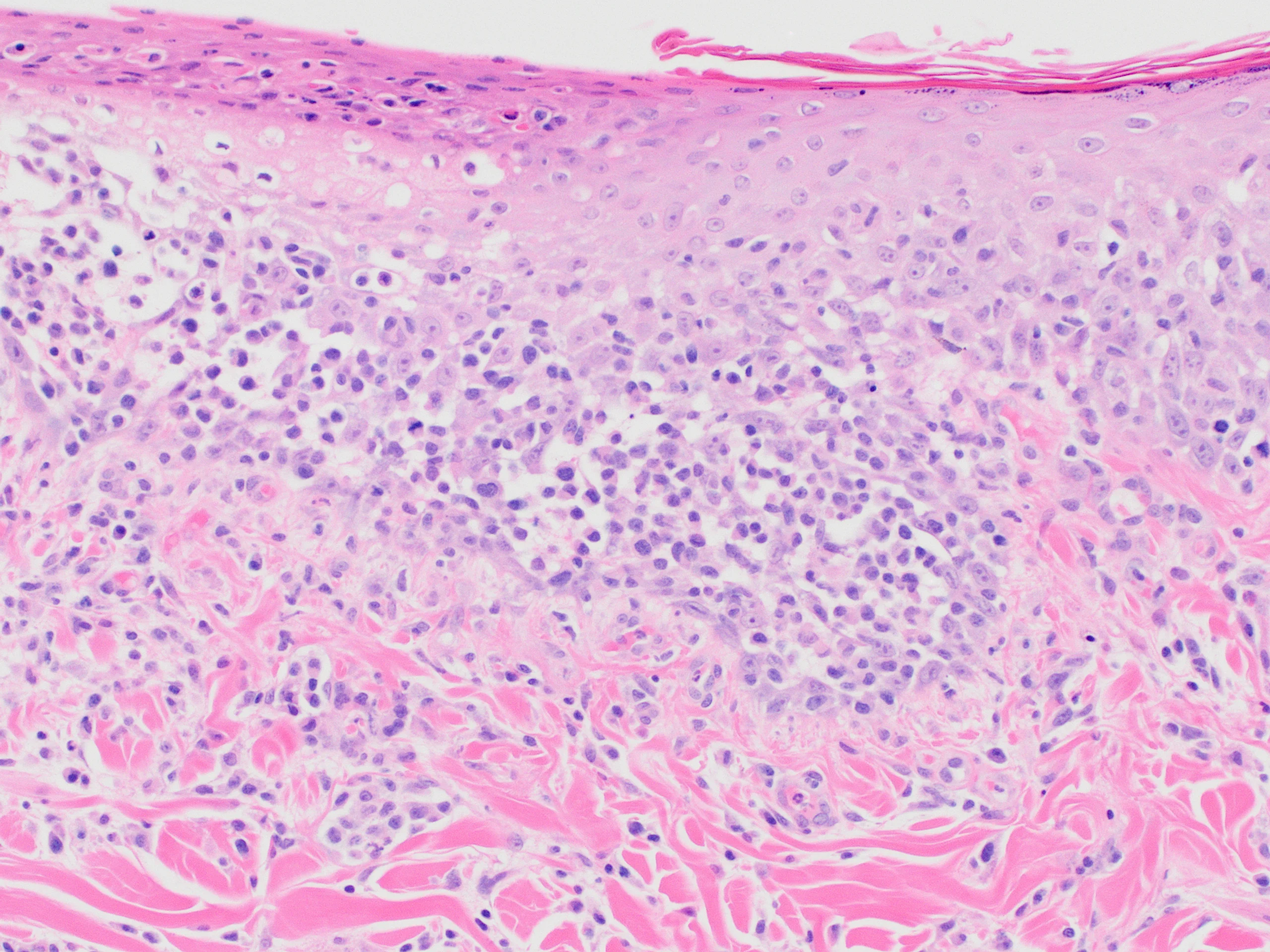 Histopathology slide of skin with numerous lymphocytes throughout epidermal layer.